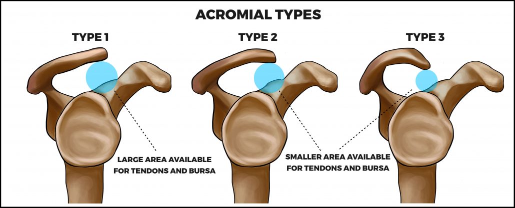tipos de acromion