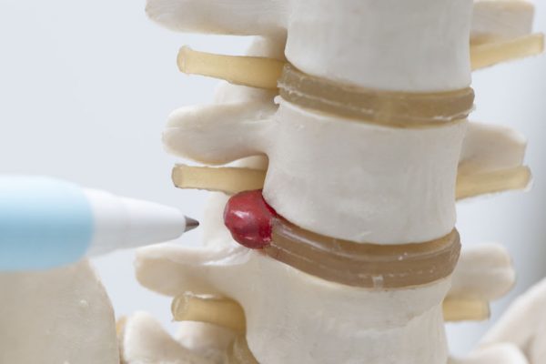 hernia discal