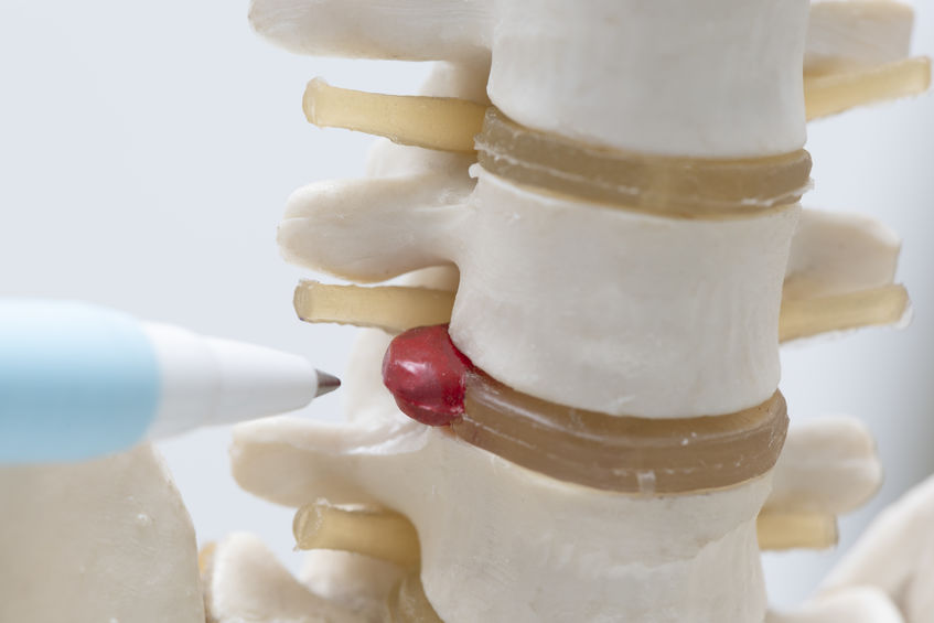 hernia discal